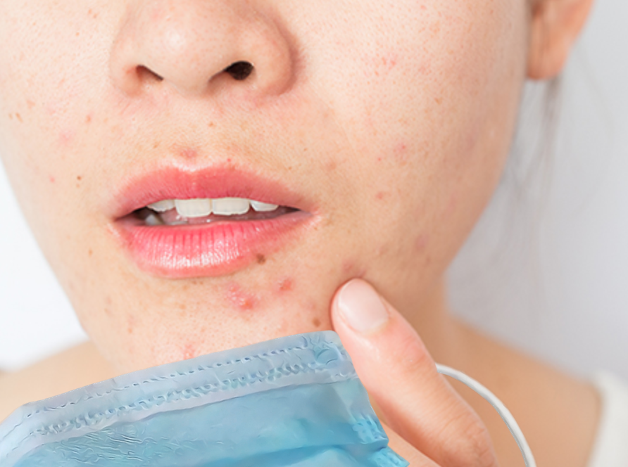 MASK-ACNE